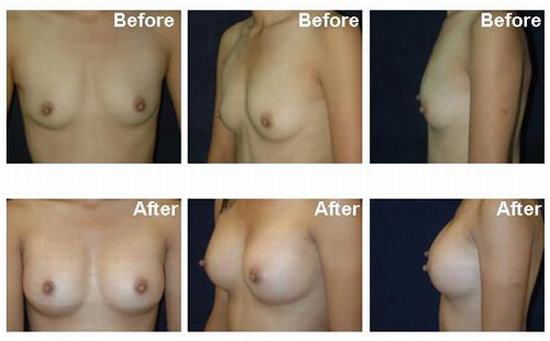 Breast-augmentation-1