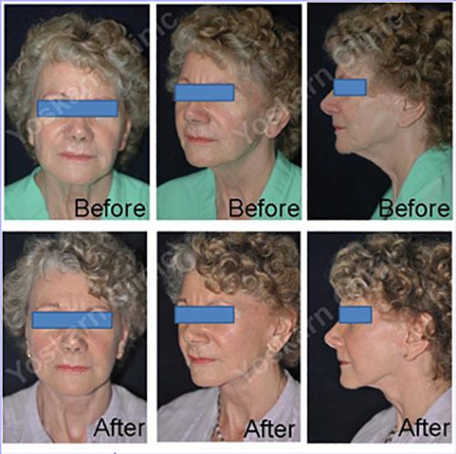 Face and Neck Lift Bangkok