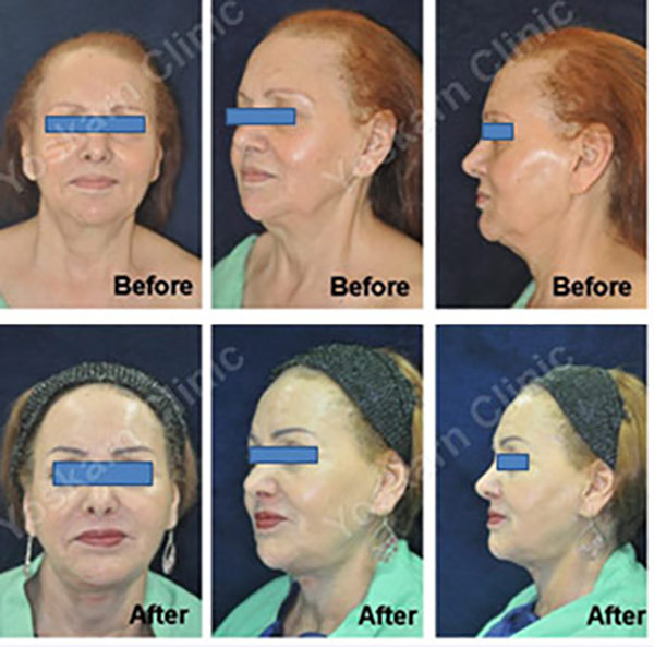 Facelift-Makeover