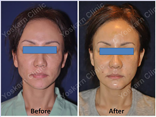 Face Fat Transfer