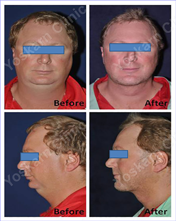 Face and Neck Liposuction