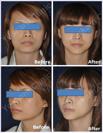 Jaw Reduction by Surgery
