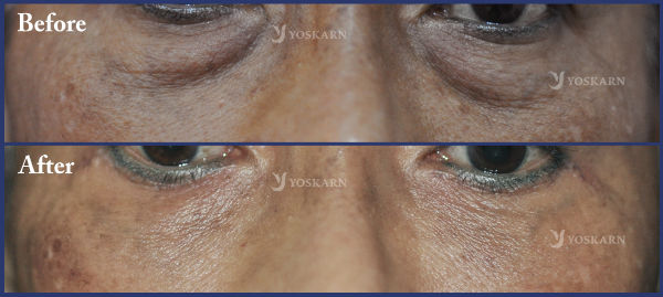 Lower Eyelid Surgery