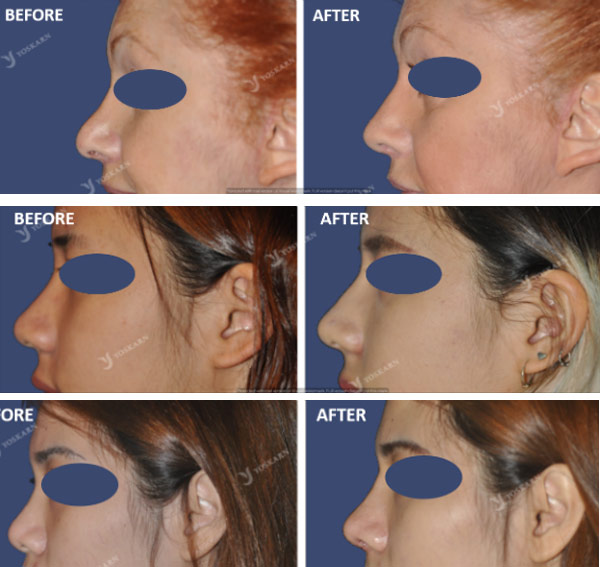 Nose Augmentation