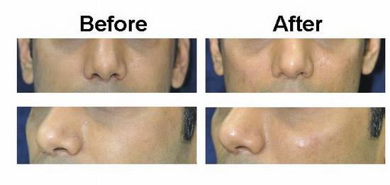 Cheek implantation