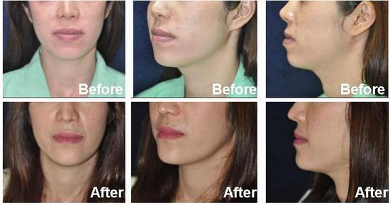 Chin augmentation