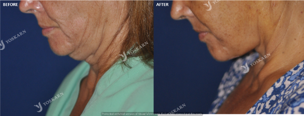 Extended Neck Contouring