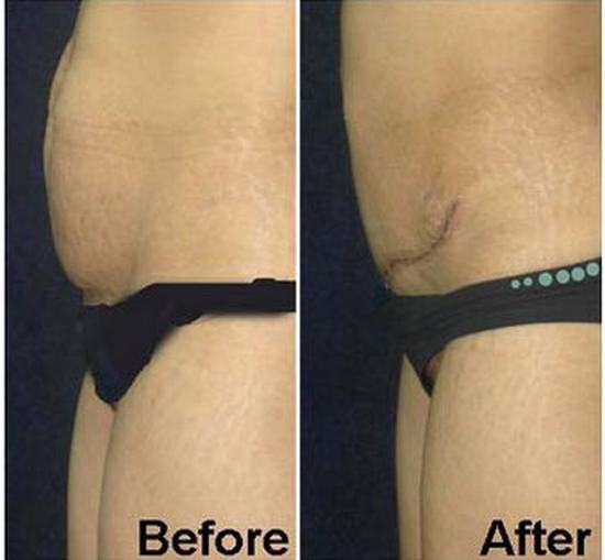 Tummy Tuck
