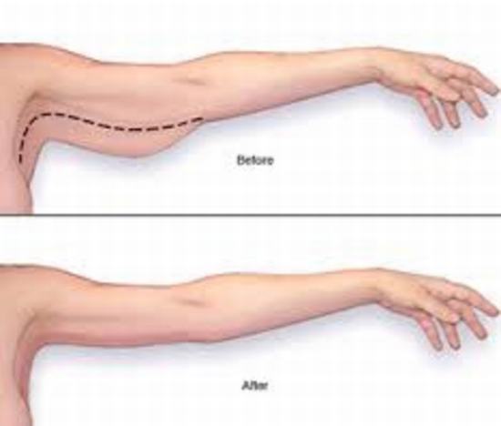 Arm Lift Surgery