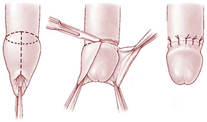 Circumcision Surgery