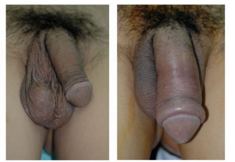 Penile Enlargement Surgery