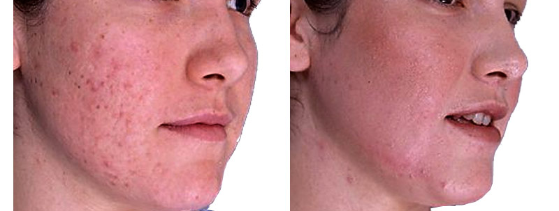 Professional Dermabrasion