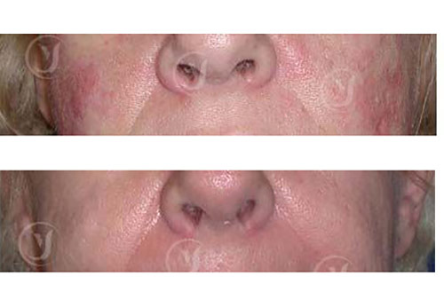 Vascular Laser Therapy
