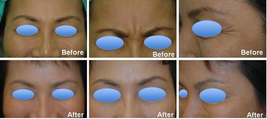 Botox Injections