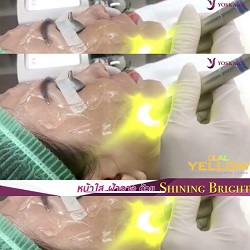 Melasma Treatment