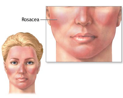 Rosacea Treatment