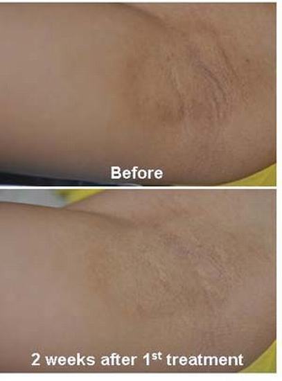 Dark Armpit