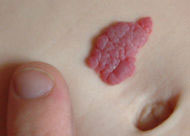 Hemangioma