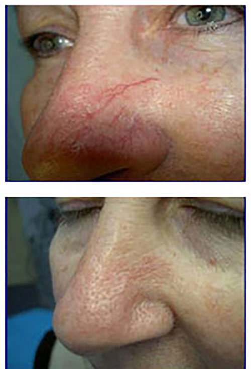 Facial Telangiectasia Treatment