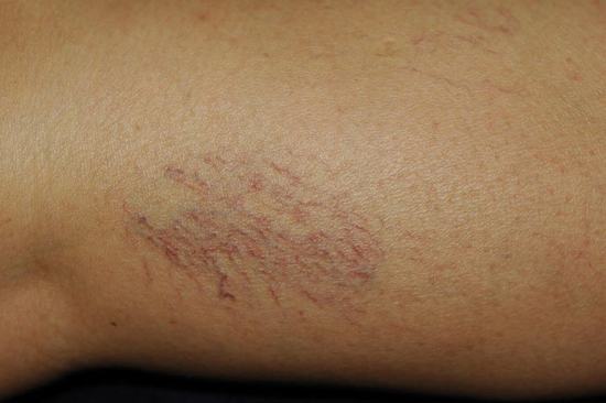 Couperose Spider Veins Treatment