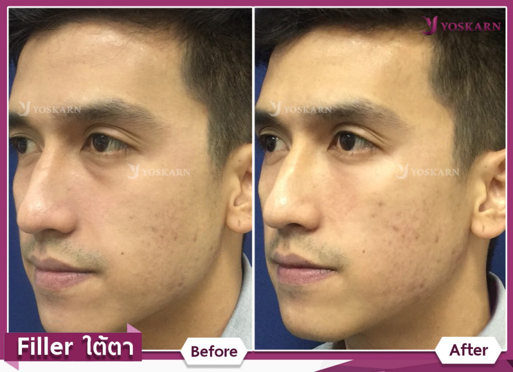 Dermal Filler Injections