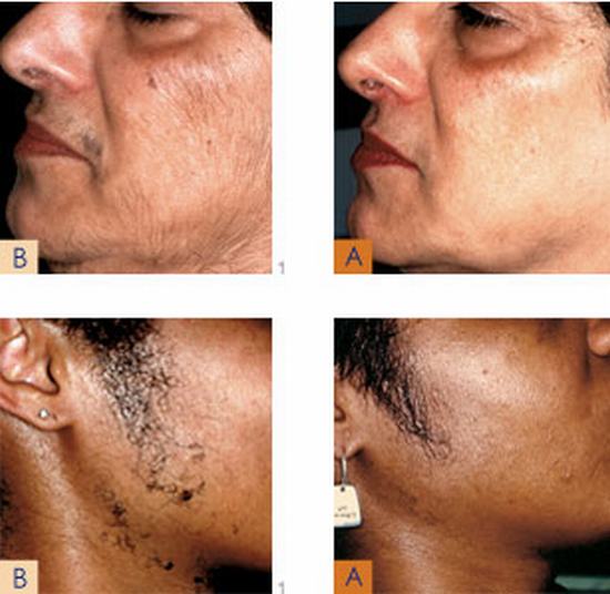 Cynosure-Elite-Before-and-After