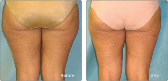 Cellulite Reduction in Bangkok