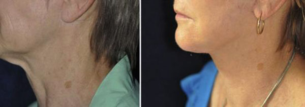 Face-and-Neck-Lift.jpg