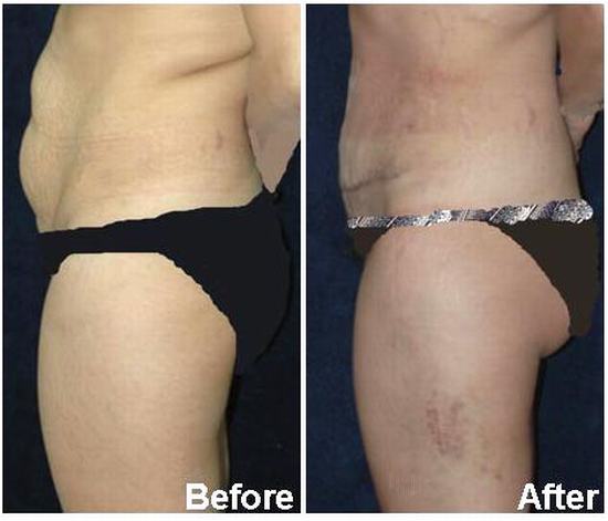 Tummy Tuck Surgery